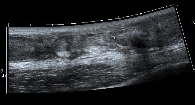 Achilles Tendon Scar Tissue No Reduction Plantarflexion